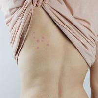 Woman with bed bug bites on her back